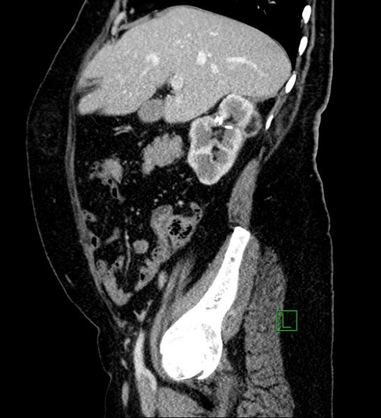 File:Bilateral sporadic synchronous clear cell renal cell carcinoma (Radiopaedia 85035-100575 G 80).jpg