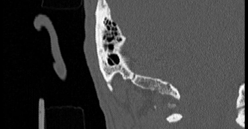Bilateral temporal bone fractures (Radiopaedia 29482-29970 Coronal non-contrast 170).jpg