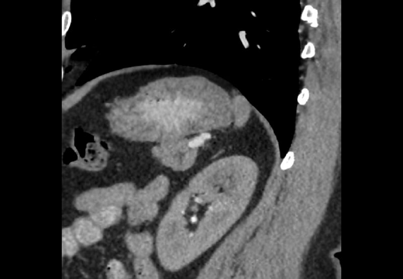 File:Bilateral urolithiasis with incidentally detected splenic artery aneurysm and left inferior vena cava (Radiopaedia 44467-48127 Ob. Sag. C+ Art. 15).jpg