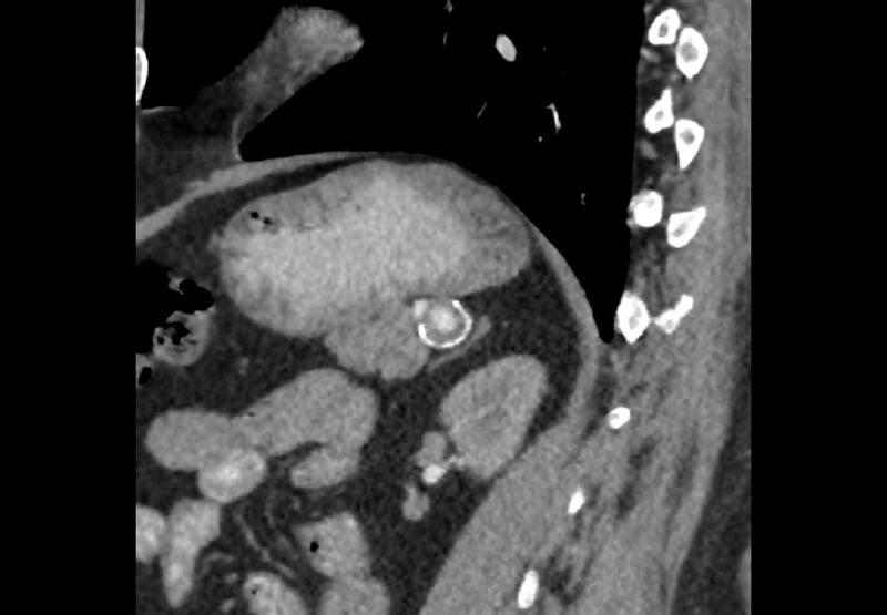 File:Bilateral urolithiasis with incidentally detected splenic artery aneurysm and left inferior vena cava (Radiopaedia 44467-48127 Ob. Sag. C+ Art. 26).jpg