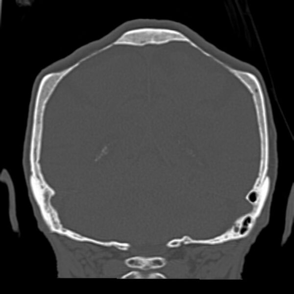 File:Biparietal osteodystrophy (Radiopaedia 46109-50463 Coronal bone window 77).jpg