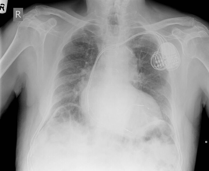 File:Biventricular pacemaker (Radiopaedia 6379).jpg