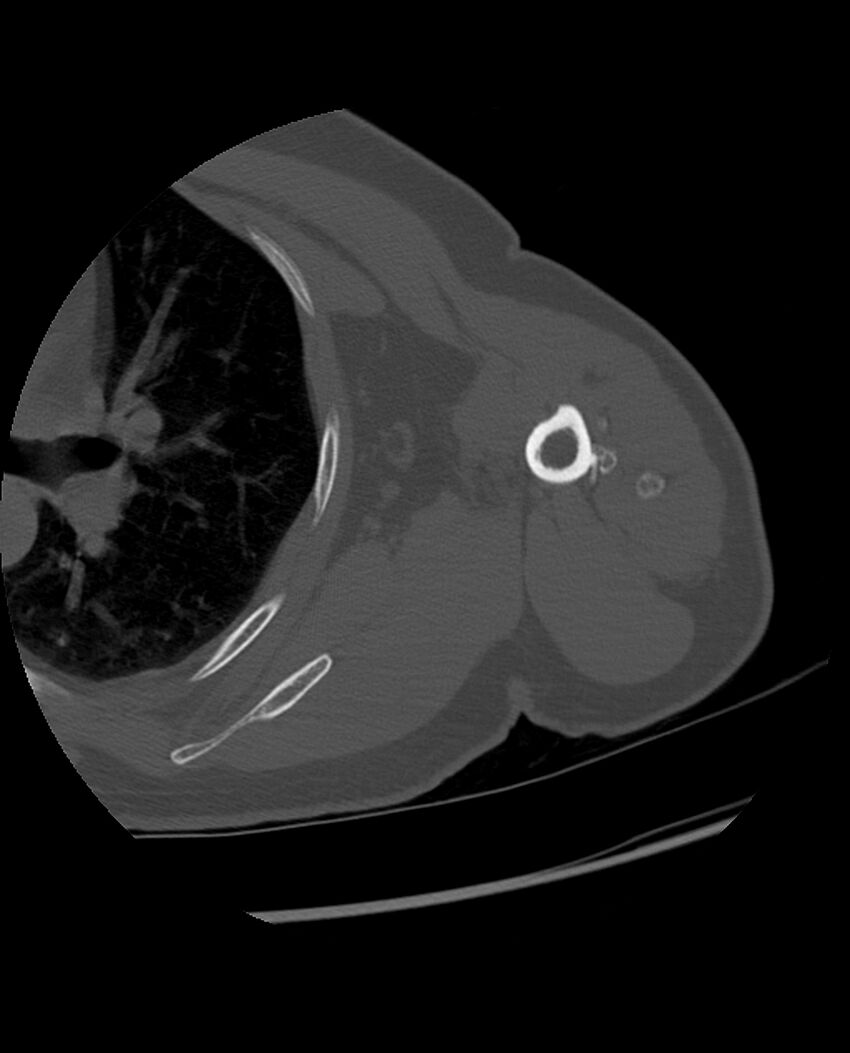 Bizarre parosteal osteochondromatous proliferation (Radiopaedia 84221-99501 Axial bone window 47).jpg