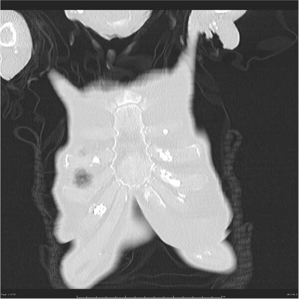 File:Boerhaave syndrome (Radiopaedia 26240-26362 Coronal lung window 1).jpg