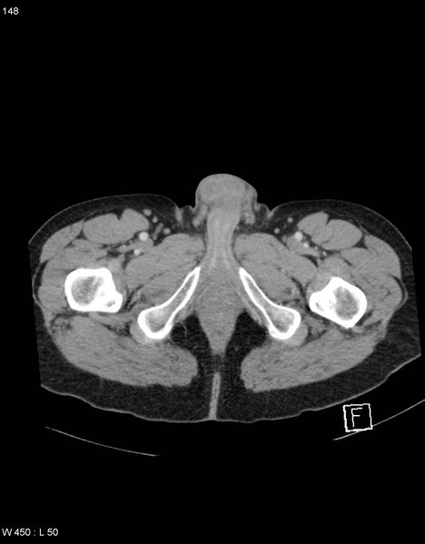 File:Boerhaave syndrome with tension pneumothorax (Radiopaedia 56794-63603 A 74).jpg