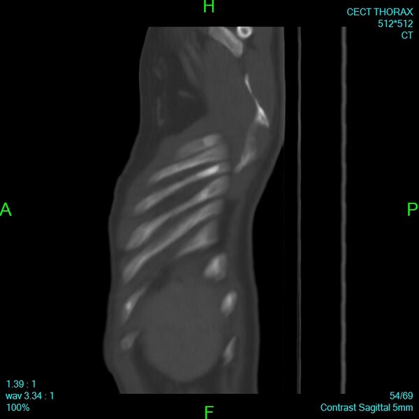 File:Bone metastases from lung carcinoma (Radiopaedia 54703-60937 Sagittal bone window 54).jpg
