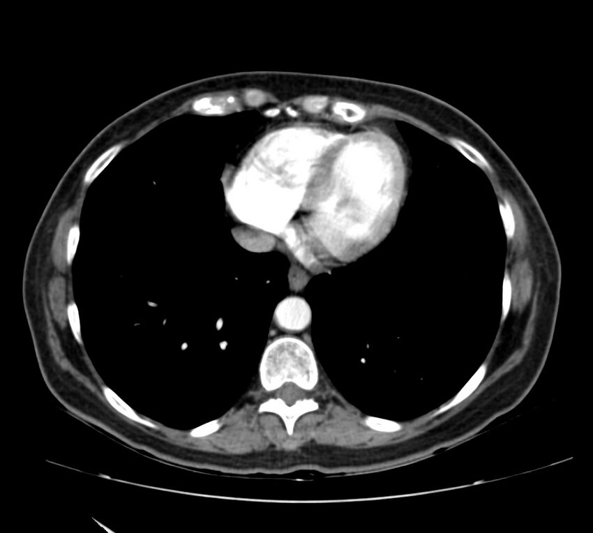 Bosniak renal cyst - type IV (Radiopaedia 22929-22953 B 1).jpg