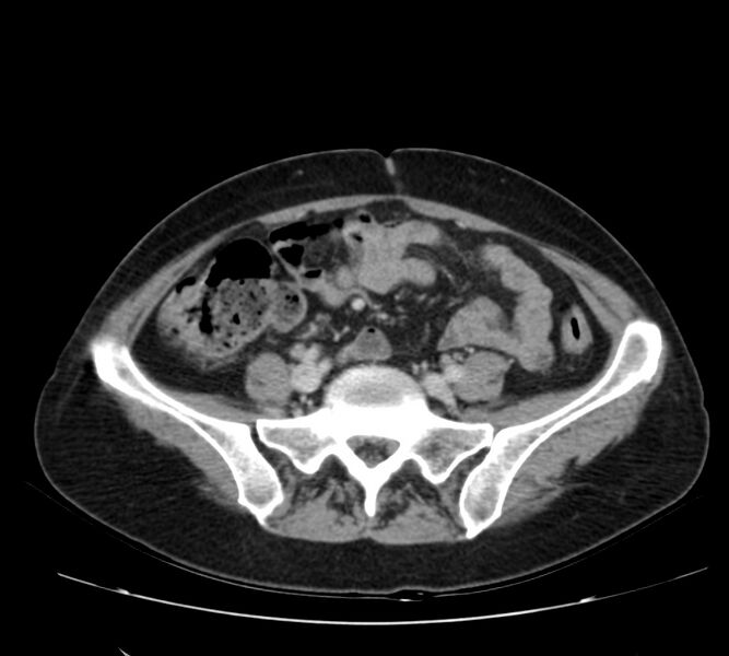 File:Bosniak renal cyst - type IV (Radiopaedia 22929-22953 C 46).jpg