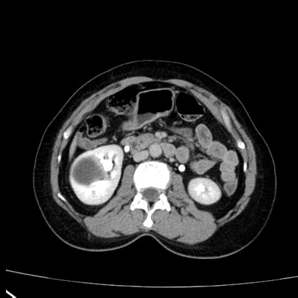 File:Bosniak renal cyst - type I (Radiopaedia 27479-27675 D 22).jpg