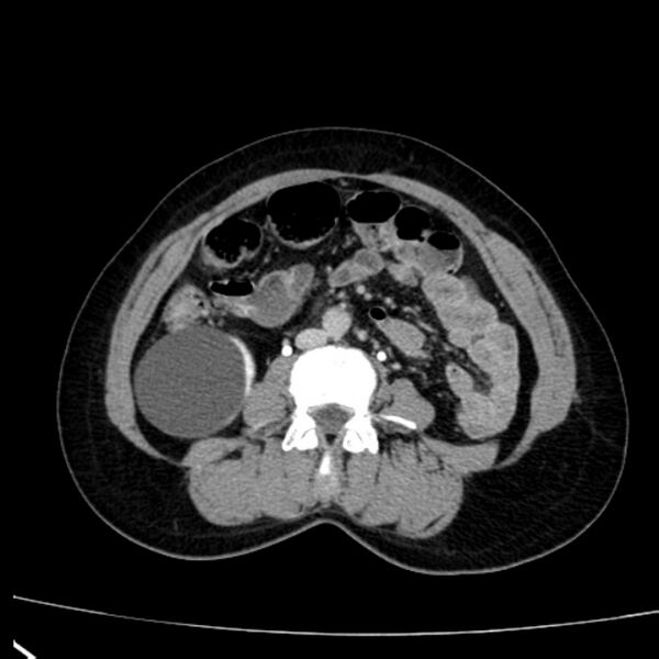 File:Bosniak renal cyst - type I (Radiopaedia 27479-27675 D 30).jpg
