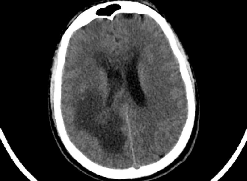 File:Brain abscess complicated by intraventricular rupture and ventriculitis (Radiopaedia 82434-96575 Axial non-contrast 70).jpg
