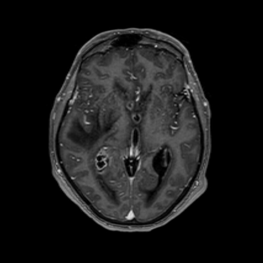 Brain abscess complicated by intraventricular rupture and ventriculitis (Radiopaedia 82434-96577 Axial T1 C+ 32).jpg