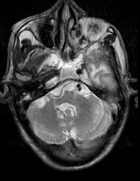 File:Brain abscess with dual rim sign (Radiopaedia 87566-103938 Axial T2 4).jpg