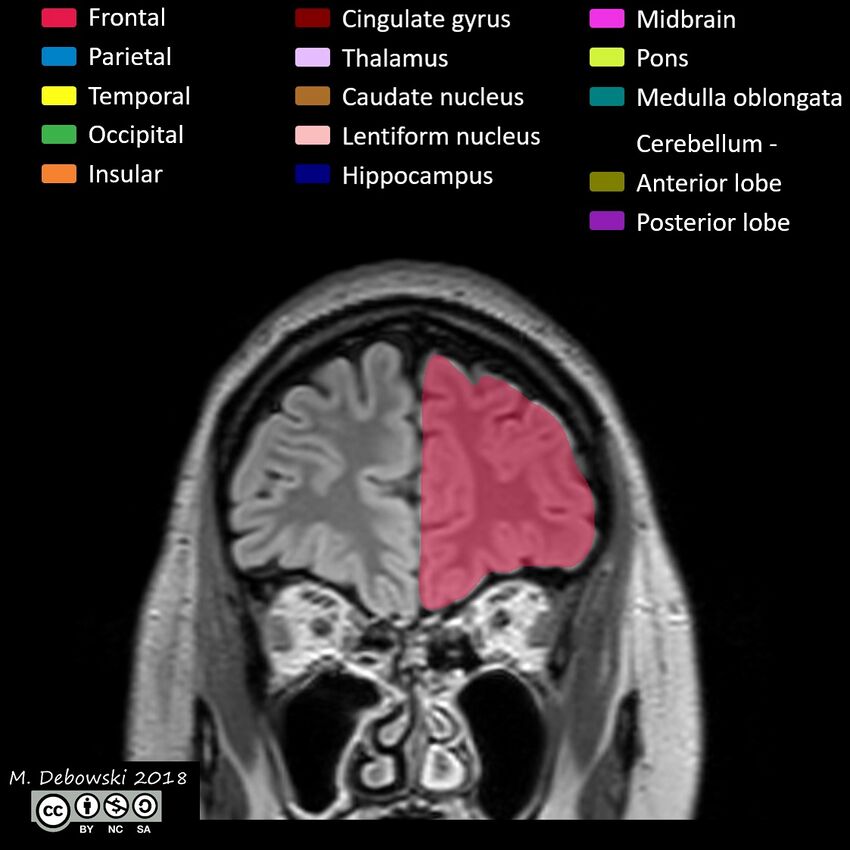 Brain lobes - annotated MRI (Radiopaedia 61691-69700 Coronal 11).JPG