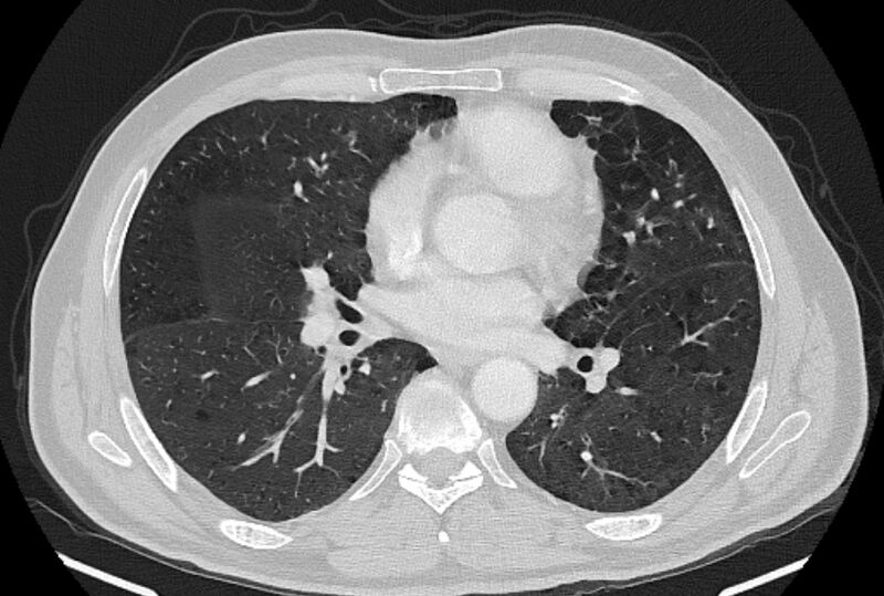 File:Brain metastases - lung cancer primary (Radiopaedia 75060-86116 Axial lung window 32).jpg