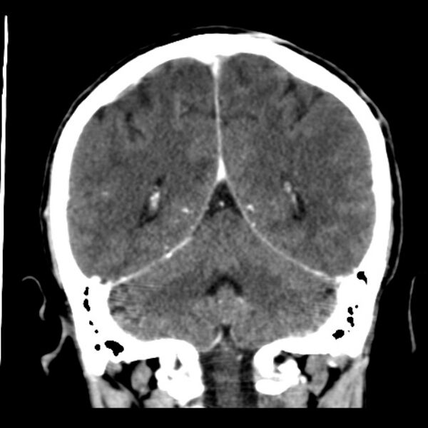 File:Brain metastases from lung cancer (Radiopaedia 24480-24781 Coronal C+ delayed 44).jpg