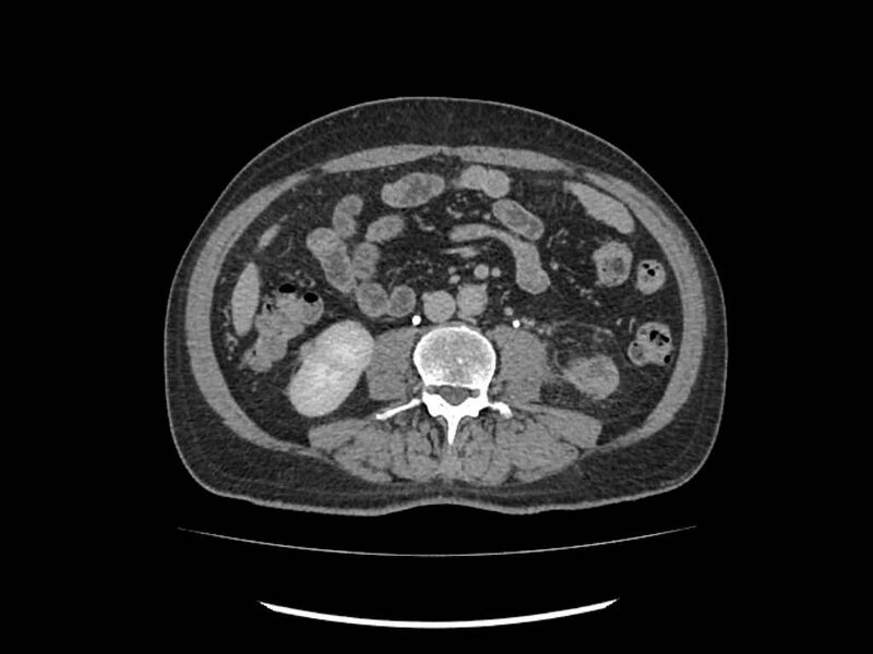 File:Brain metastases from renal cell carcinoma (Radiopaedia 42222-45328 Axial C+ delayed 153).jpg