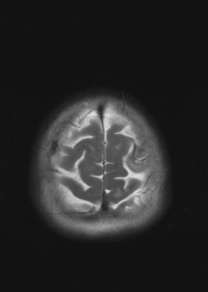 File:Brain metastases from squamocellular lung cancer (Radiopaedia 56515-63222 Axial T2 23).jpg