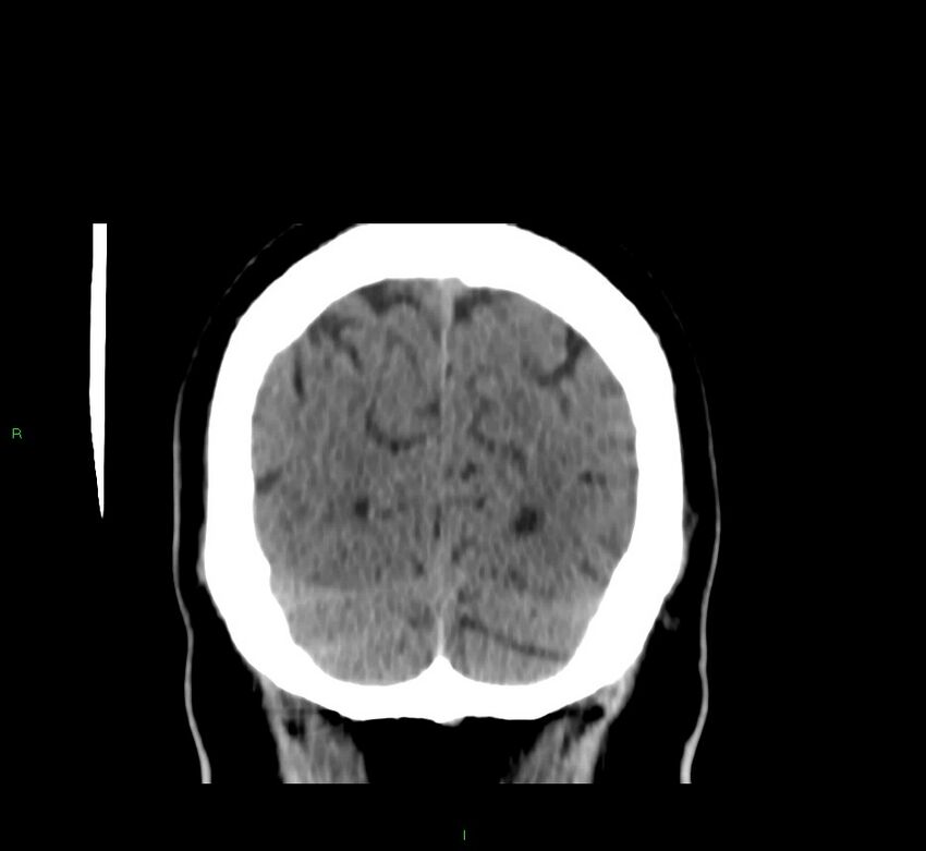 Brainstem hemorrhage (Radiopaedia 58794-66028 Coronal non-contrast 13).jpg