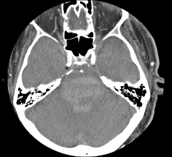 File:Brainstem hemorrhage (Radiopaedia 58794-66028 D 61).jpg