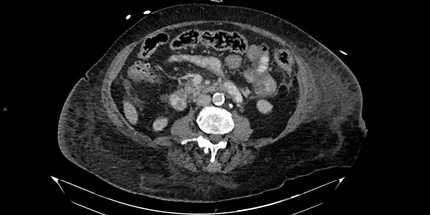Breast cancer pelvic bony metastases (Radiopaedia 84470-99824 Axial bone window 1).jpg