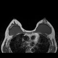 Breast implants - MRI (Radiopaedia 26864-27035 Axial T1 32).jpg