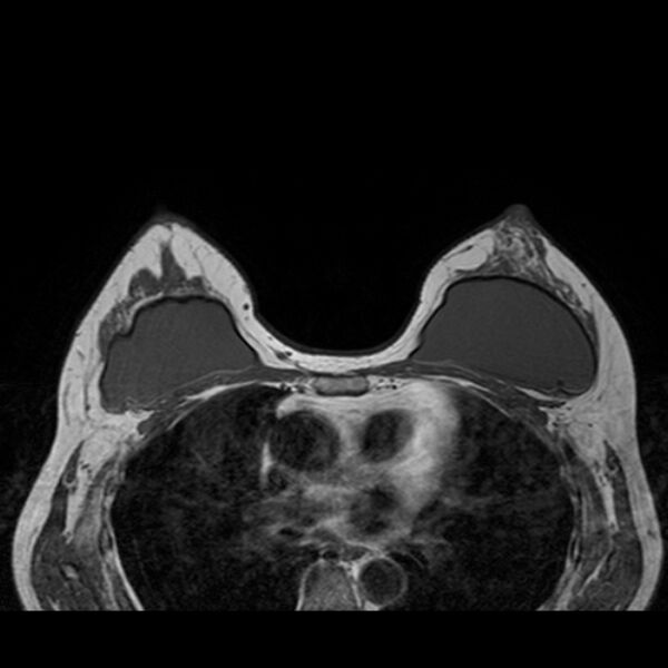File:Breast implants - MRI (Radiopaedia 26864-27035 Axial T1 32).jpg
