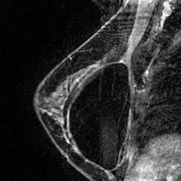 File:Breast implants - MRI (Radiopaedia 26864-27035 Sagittal T2 108).jpg