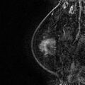 Breast implants - MRI (Radiopaedia 26864-27035 Sagittal T2 9).jpg