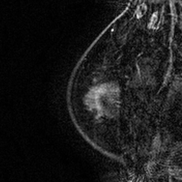 File:Breast implants - MRI (Radiopaedia 26864-27035 Sagittal T2 9).jpg