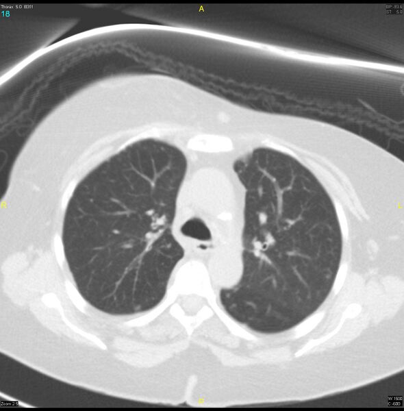 File:Breast primary with lung and bone metastases (Radiopaedia 40620-43228 Axial lung window 18).jpg