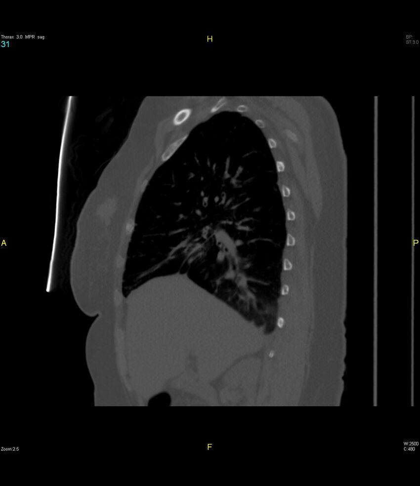 Breast primary with lung and bone metastases (Radiopaedia 40620-43228 Sagittal bone window 31).jpg