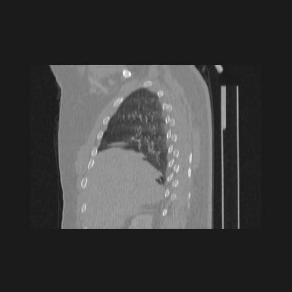 File:Bronchial atresia (Radiopaedia 60685-68439 Sagittal lung window 18).jpg