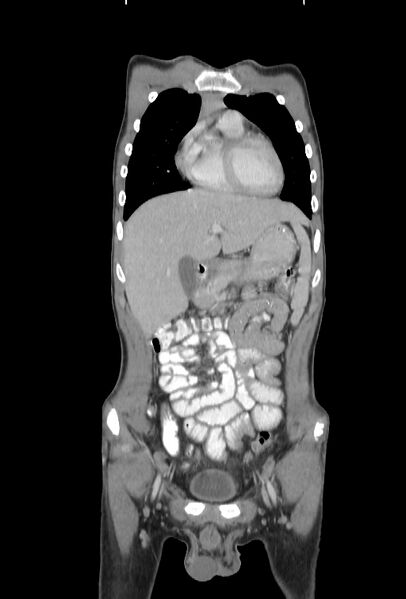 File:Bronchial carcinoid tumor (Radiopaedia 57187-64090 B 12).jpg