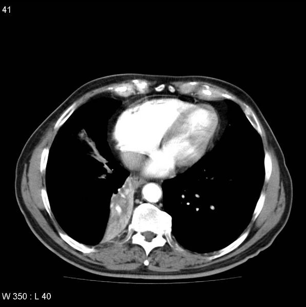 File:Bronchial carcinoid tumor with right lower lobe collapse (Radiopaedia 29060-29422 A 40).jpg