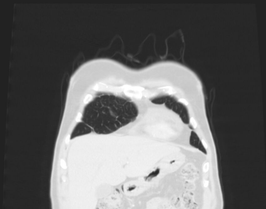 Bronchogenic carcinoma with lymphangitic spread (Radiopaedia 29002-29357 Coronal lung window 3).jpg