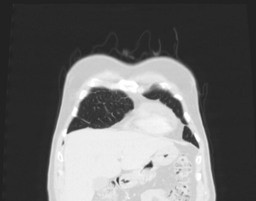 Bronchogenic carcinoma with lymphangitic spread (Radiopaedia 29002-29357 Coronal lung window 4).jpg