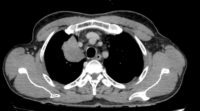 File:Bronchogenic carcinoma with superior vena cava syndrome (Radiopaedia 36497-38054 Axial C+ delayed 16).jpg