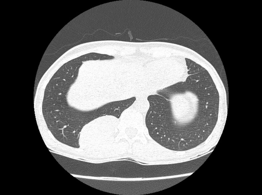 Bronchogenic cyst (Radiopaedia 80273-93615 Axial lung window 25).jpg