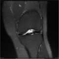 Bucket handle tear - lateral meniscus (Radiopaedia 7246-8187 Coronal T2 fat sat 14).jpg