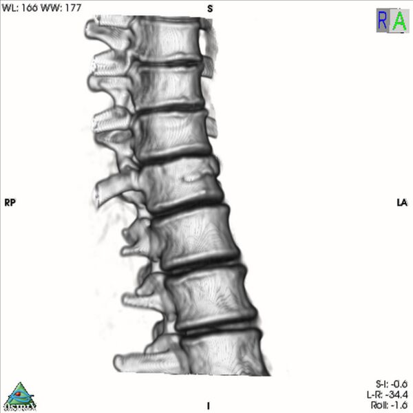 File:Bulging of paraspinal line in traumatic thoracal spinal compression fracture (Radiopaedia 29221-35872 3D VR 6).jpg
