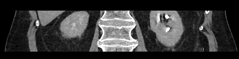 File:Buried bumper syndrome - gastrostomy tube (Radiopaedia 63843-72575 Coronal Inject 69).jpg