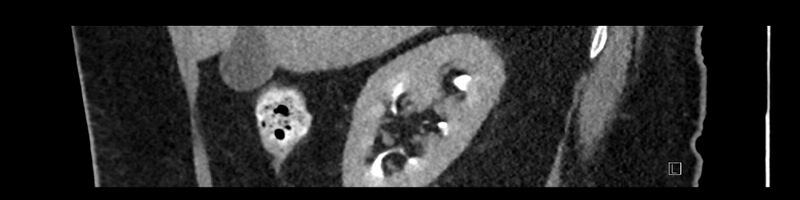 File:Buried bumper syndrome - gastrostomy tube (Radiopaedia 63843-72575 Sagittal Inject 91).jpg