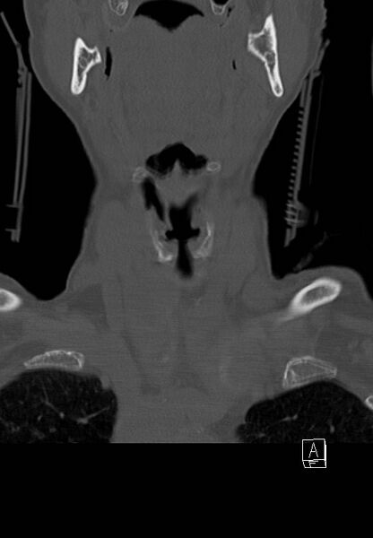 File:C1 and C2 (peg) fractures (Radiopaedia 36618-38184 Coronal bone window 1).jpg