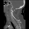 C1 anterior arch (plough) fracture - type 1 (Radiopaedia 76181-87720 Sagittal bone window 50).jpg