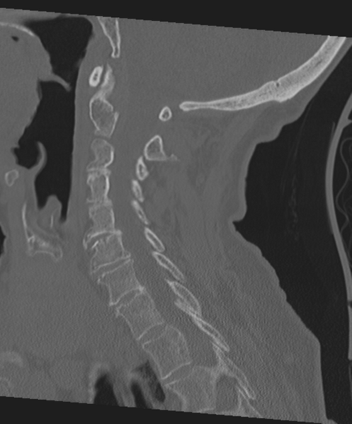 File:C2 fracture with vertebral artery dissection (Radiopaedia 37378-39199 Sagittal bone window 45).png