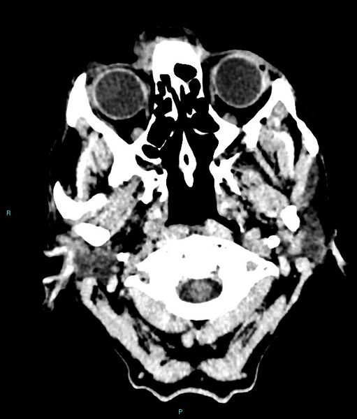 File:Calcified cerebral emboli from left ventricular thrombus (Radiopaedia 84420-99758 Axial non-contrast 87).jpg
