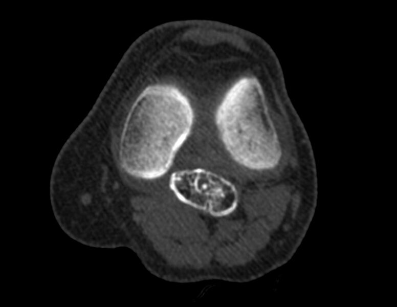 File:Calcified hematoma - popliteal fossa (Radiopaedia 63938-72763 Axial bone window 16).jpg