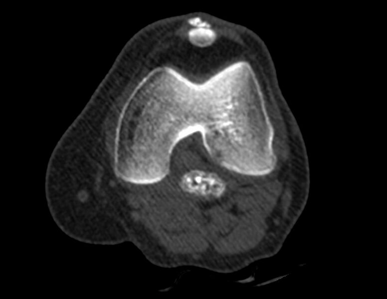 File:Calcified hematoma - popliteal fossa (Radiopaedia 63938-72763 Axial bone window 8).jpg