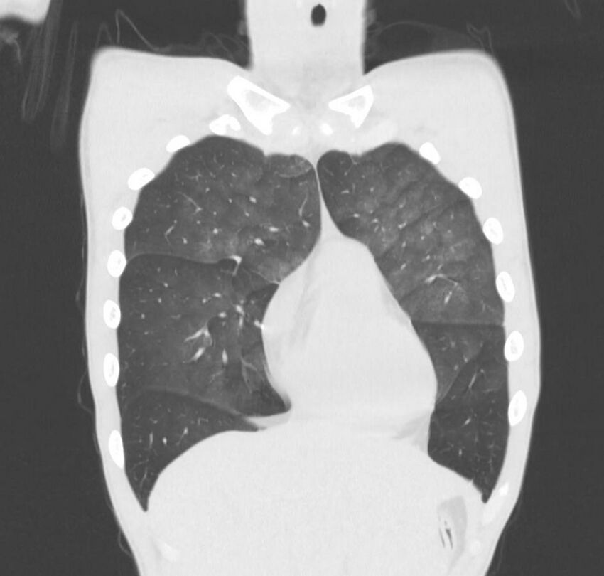Cannabis-induced diffuse alveolar hemorrhage (Radiopaedia 89834-106946 Coronal lung window 69).jpg
